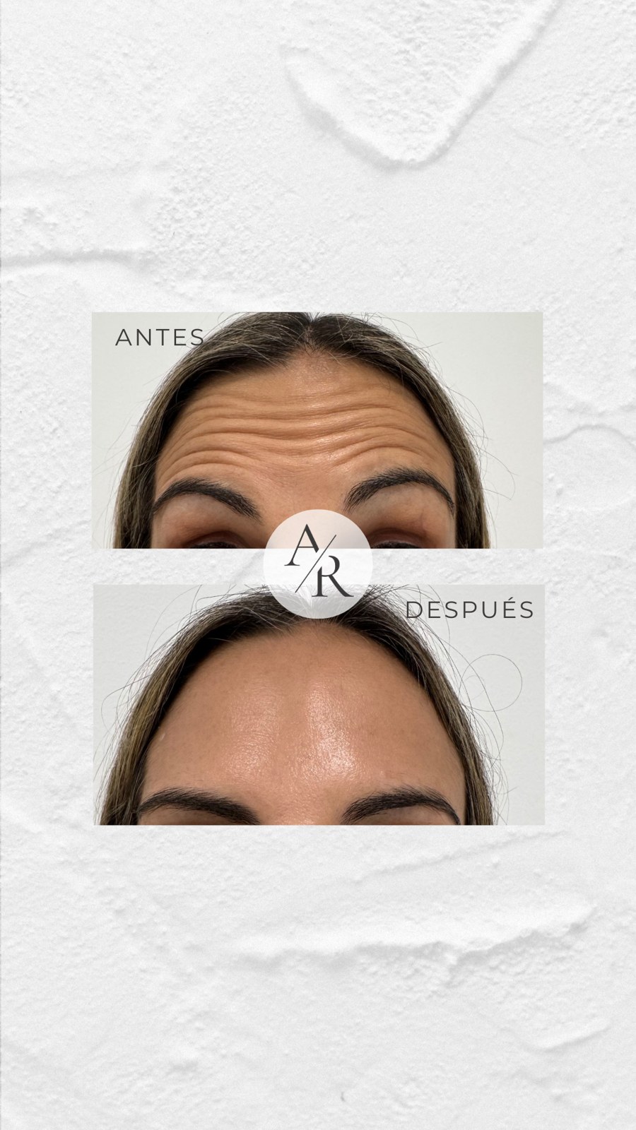 Resultado tratamiento con neuromoduladores en frente, antes y después